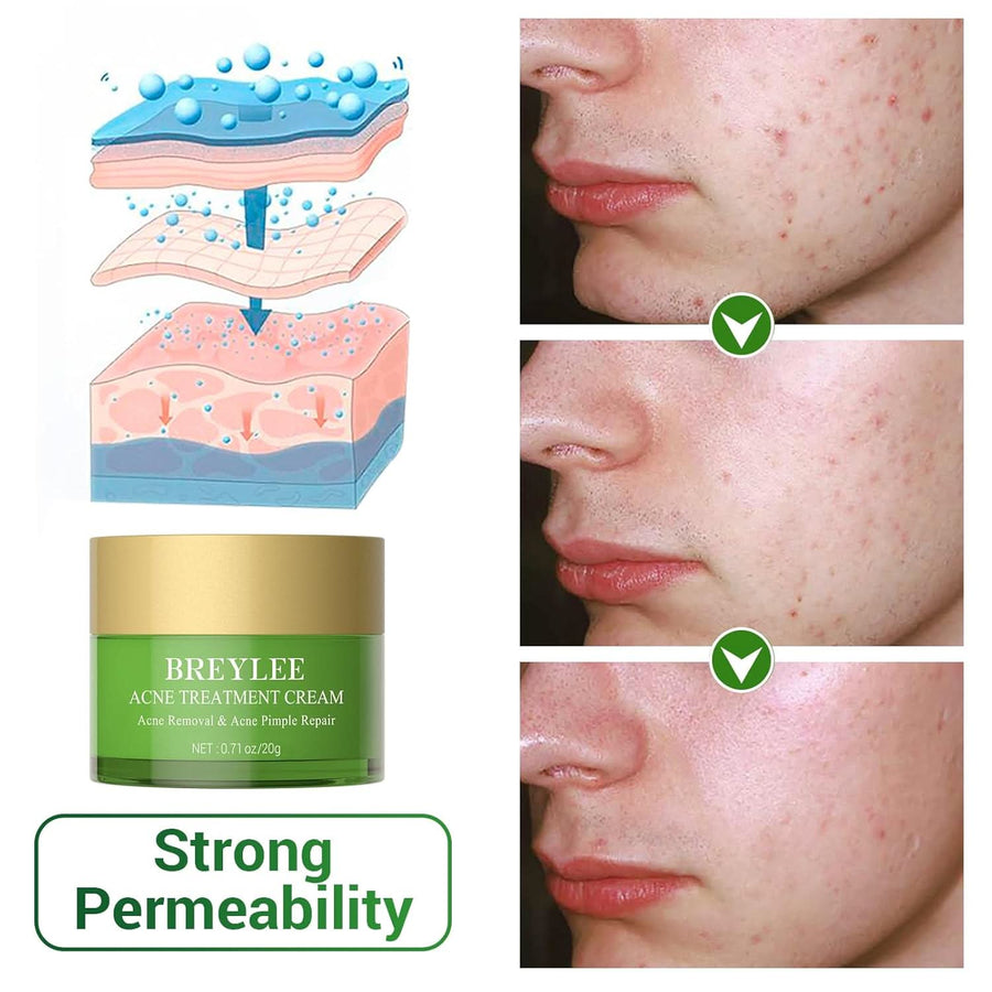 BREYLEE Acne Treatment Cream, Tea Tree Oil Acne Cream for Clearing Severe Acne, Breakout, Remove Pimple and Repair Skin (20ml,0.7oz) - Sccoti