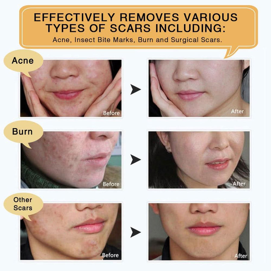 Scar Removal Cream - TCM Scar Cream for Surgical Scars, Acne Skin Care Cream, Acne Treatment Cream for Scars, Burns, Stretch Marks, Acne Spots - Sccoti