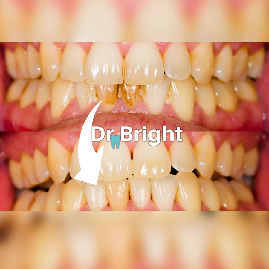 Dental Scaler (Compare to Densine™) - Sccoti